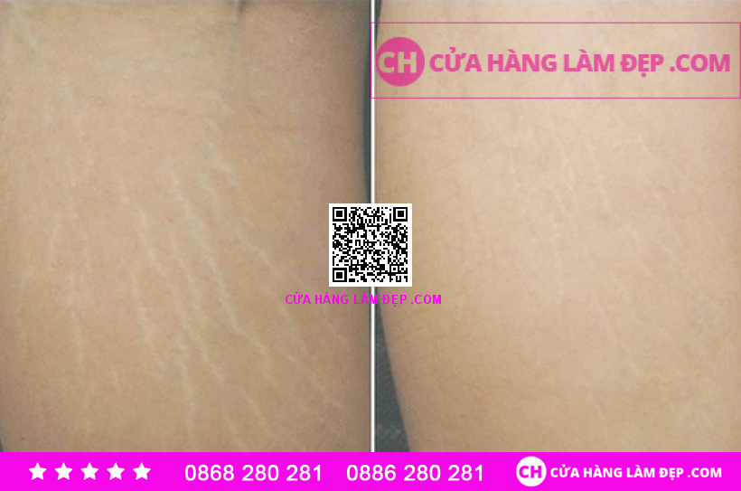 Tinh Chất Trị Rạn Nứt Da Toàn Thân Murad Cellulite Firm and Tone Serum